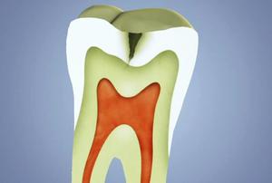 alt: Postupující zubní kaz. Zdroj Wikimedia Commons, autor DentalCare – Vlastní dílo, CC BY 3.0