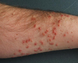alt: Akutní fáze cerkáriové dermatitidy na zápěstí opakovaně napadeného člověka 3 dny po průniku cerkárií.