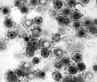 alt: Virové částice viru herpes simplex; snímek z transmisního elektronového mikroskopu. Zdroj Wikimedia Commons, autor CDC / Dr. Fred Murphy, volné dílo / public domain.
