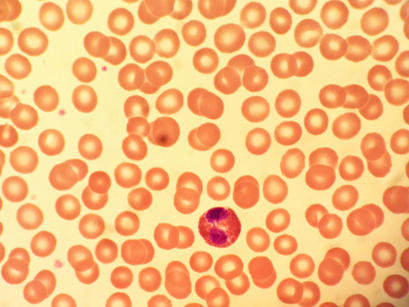 alt: Mikroskopický snímek lidské krve. Převládají červené krvinky, které jsou při pohledu shora kruhovité. Větší buňka trochu níže od středu je bílá krvinka, malé tmavočervené skvrny jsou krevní destičky. Zdroj Wikimedia Commons, autor Iceclanl, licence Creative Commons Uveďte autora-Zachovejte licenci 3.0 Unported.