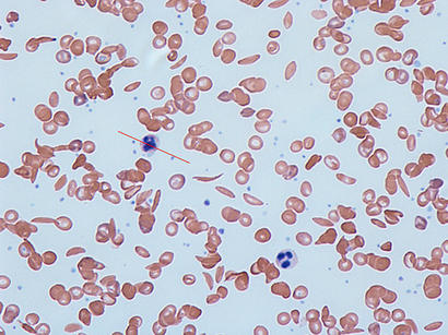 alt: Při srpkovité anémii se v krvi objevují abnormální protažené erytrocyty. Zdroj Wikimedia Commons, autor Dr Graham Beards, licence Creative Commons Attribution-Share Alike 3.0 Unported.