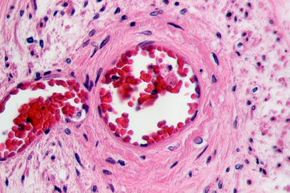 alt: Průřez krevní cévou, kterou obklopuje hladká svalovina (intenzivněji růžová oblast). Adrenalin působí právě na tyto svalové buňky. Zdroj Wikimedia commons, autor Patho, licence CC BY-SA 3.0.