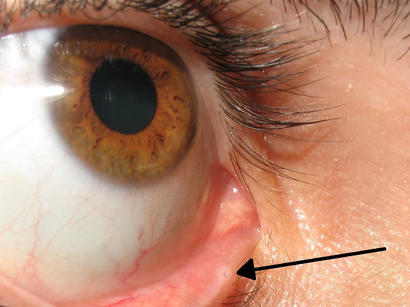 alt: Jamky ve vnitřních koutcích očí (*označeno šipkou*) slouží k odvádění přebytečných slz. Zdroj Wikimedia Commons, autor Diogo Melo Rocha, úpravy Jan Kolář, licence CC BY 2.5.
