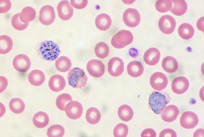 alt: Červené krvinky napadené prvokem *Plasmodium vivax* (modře). Tento parazit je jedním z pěti druhů, které u člověka vyvolávají malárii. Zdroj Wikimedia Commons, autor Ed Uthman, licence CC BY 2.0.