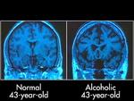 alt: Na snímku vidíte mozek mozek abstinenta (vlevo) a alkoholika. Jsou zde zřejmé strukturní změny mozku vpravo.