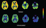 alt: Mozková aktivita u člověka střízlivého (nahoře) a člověka pod vlivem alkoholu (dole). Zdroj: NIAAA